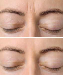 Before and after brow treatment — softened lines and natural rejuvenation