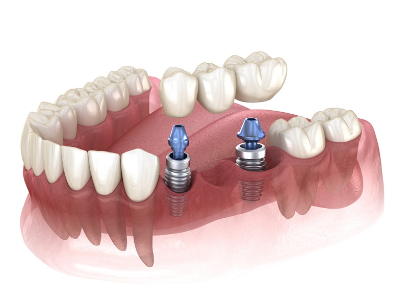 Dental implant model showing multiple implants supporting full arch restoration