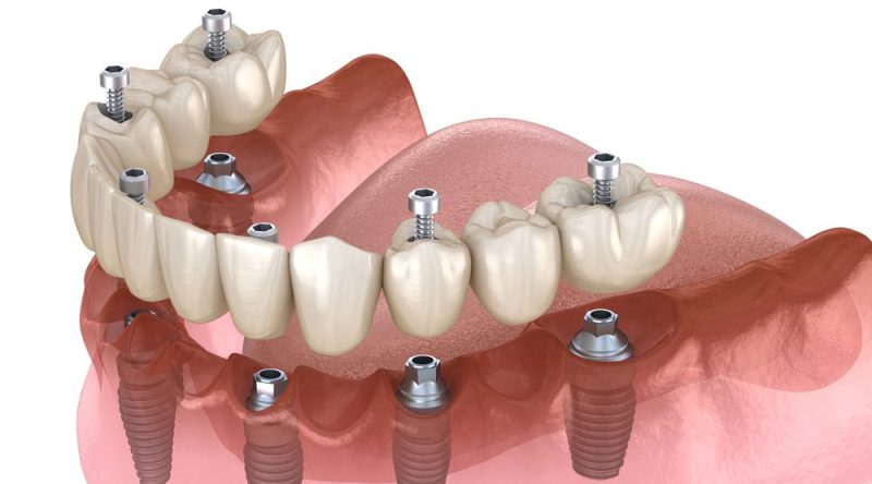 Full-arch dental implant restoration with multiple implants supporting fixed bridge