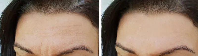 Before and after forehead smoothing — reduced wrinkles and relaxed expression