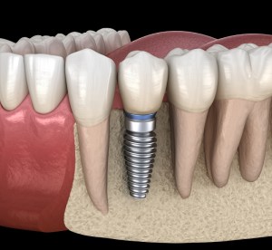 Single dental implant with crown integrated into natural teeth
