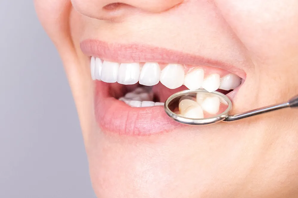 Banner perfect white teeth veneer smile with dental mirror close up