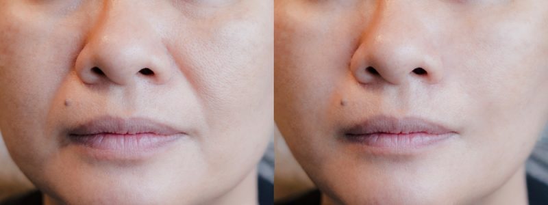 Before and after lip enhancement — subtle volume and smoother contour